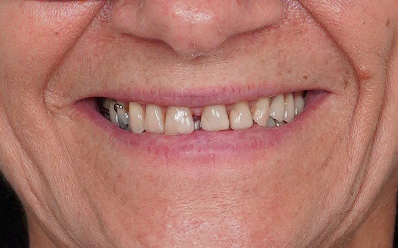 Sorriso prima del trattamento, caso 1: corone in zirconio su denti naturali e impianti
