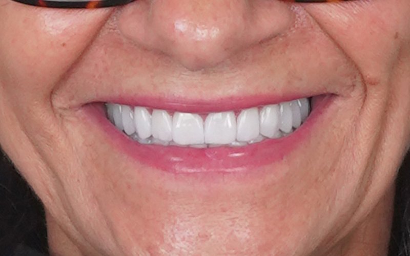 Sorriso dopo il trattamento, caso 1: corone in zirconio su denti naturali e impianti