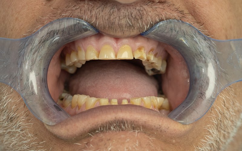 Sorriso prima del trattamento, caso 2: corone in zirconio su denti naturali