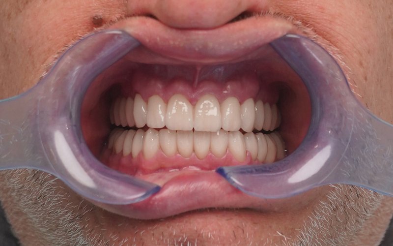 Sorriso dopo il trattamento, caso 2: corone in zirconio su denti naturali