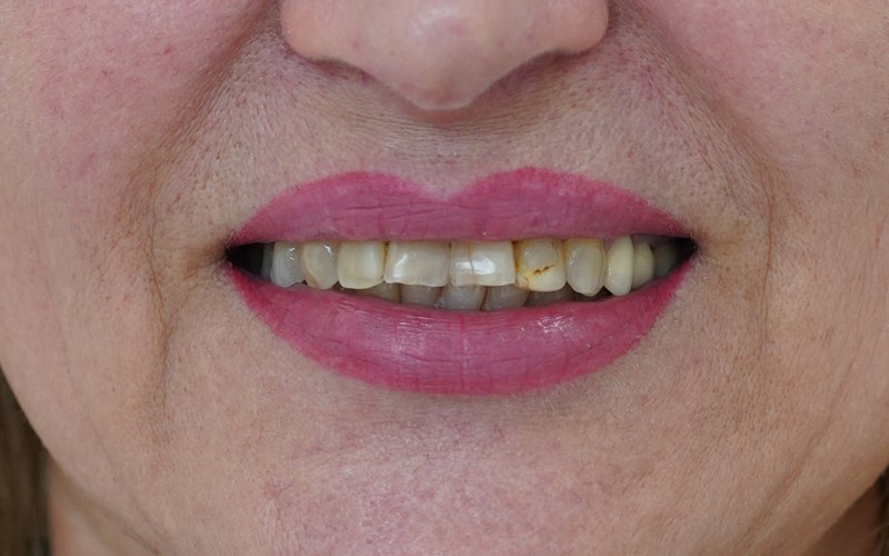 Sorriso prima del trattamento, caso 3: corone in zirconio-ceramica su denti naturali e impianti
