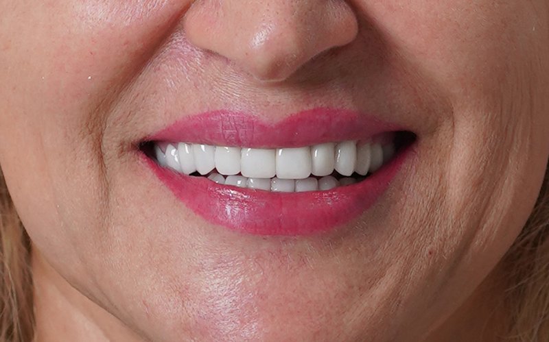 Sorriso dopo il trattamento, caso 3: corone in zirconio-ceramica su denti naturali e impianti