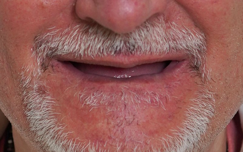 Sorriso prima del trattamento, caso 5: riabilitazione totale all-on-6 con corone in zirconio