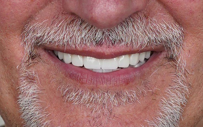 Sorriso dopo il trattamento, caso 5: riabilitazione totale all-on-6 con corone in zirconio