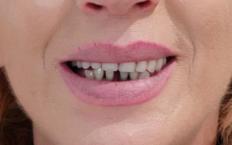 Sorriso prima del trattamento, caso 6: riabilitazione totale all-on-6 con impianti zigomatici e pterigoidei e corone in zirconio