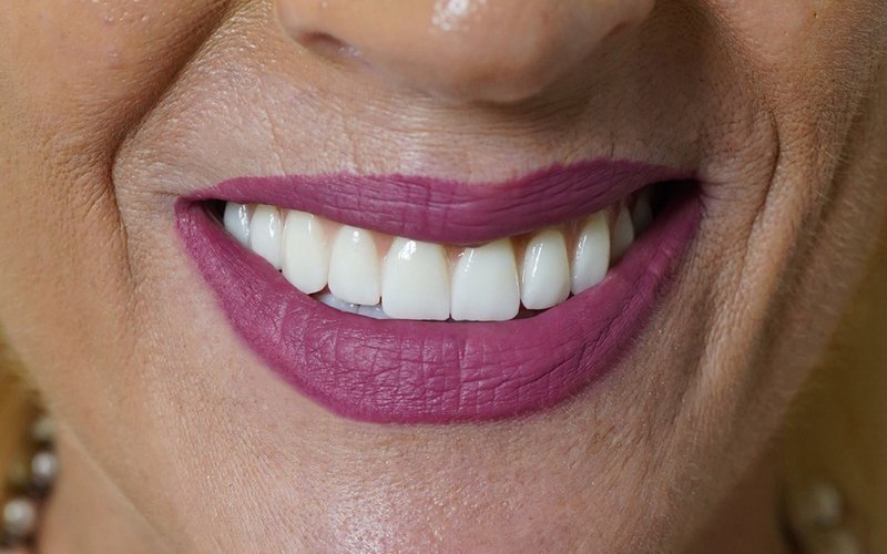 Sorriso dopo il trattamento, caso 6: riabilitazione totale all-on-6 con impianti zigomatici e pterigoidei e corone in zirconio