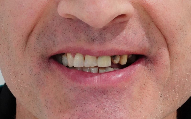 Sorriso prima del trattamento, caso 4: corone in zirconio su denti naturali e impianti