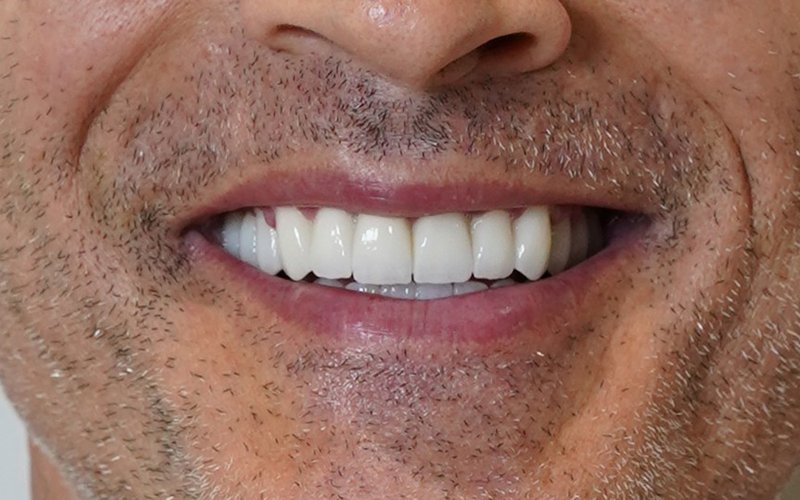 Sorriso dopo il trattamento, caso 4: corone in zirconio su denti naturali e impianti